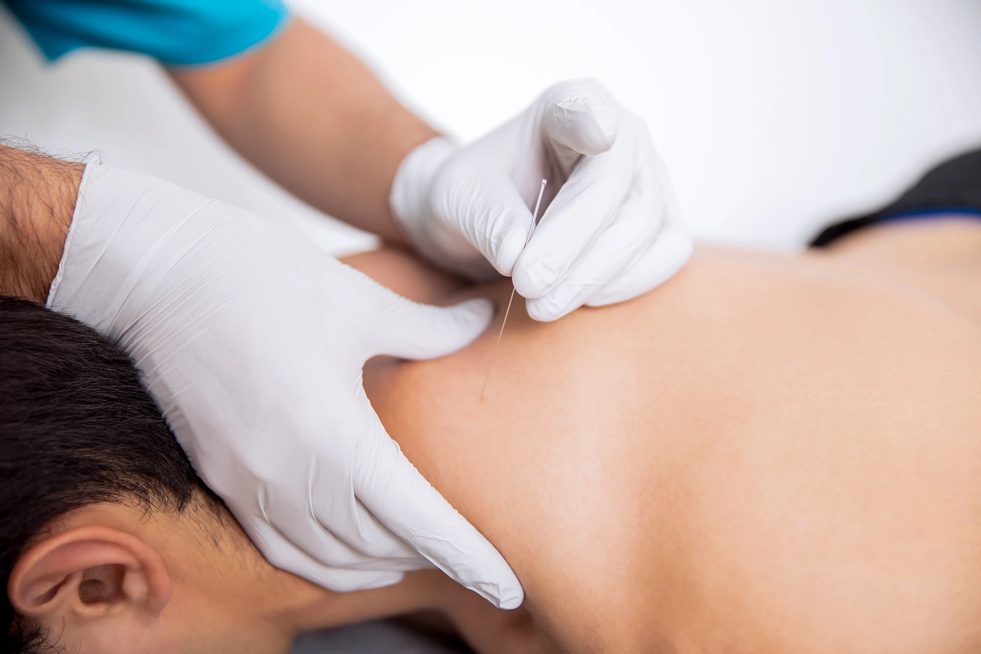 Acupuntura - Duo Fisioterapia Avançada | Suzano